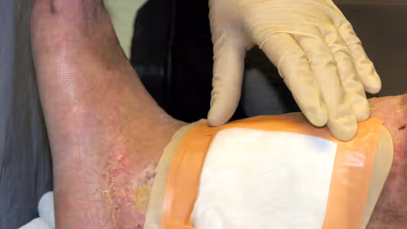 Second carcass-eating fly species cleared by FDA for maggot wound therapy